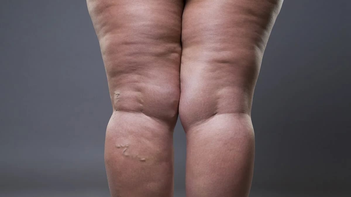 Lipedema: o que é, tipos, sintomas, Mounjaro e tratamentos modernos